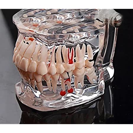 歯列模型 疾患展示模型 人体解剖モデル