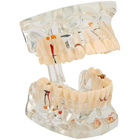 歯列模型 疾患展示模型 人体解剖モデル
